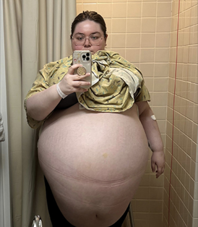 Her belly was getting bigger and bigger – doctors were shocked when they saw what came out