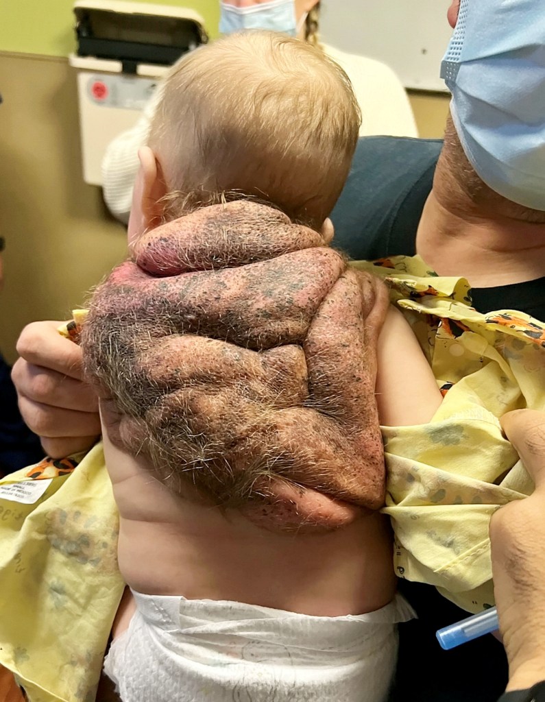 My ‘Ninja Turtle baby’ boy was born with a shell — he’s my superhero